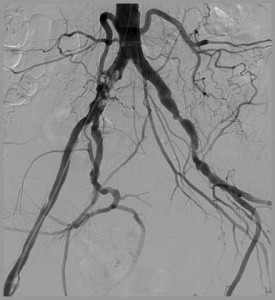 Bifurcation Atherosclerosis