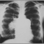 Chest X-Ray
