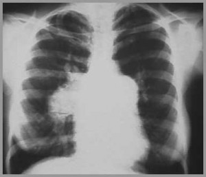 Chest X-Ray