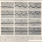 Electrocardiograph of Coronary Thrombosis