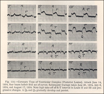 Electrocardiograph of Coronary Thrombosis