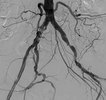 Bifurcation Atherosclerosis